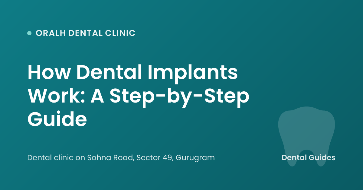 How Dental Implants Work: A Step-by-Step Guide
