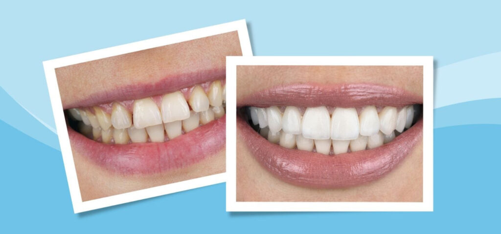 Dental Veneers