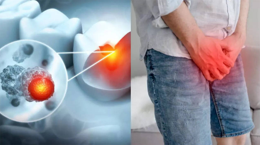 Man With Toothache Diagnosed with Prostate Cancer.