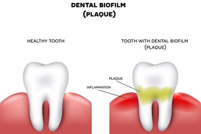 Habits that cause plaque buildup on your teeth
