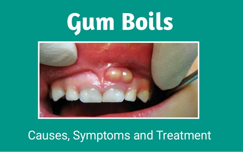 Gum boils: Causes, Symptom, Treatment