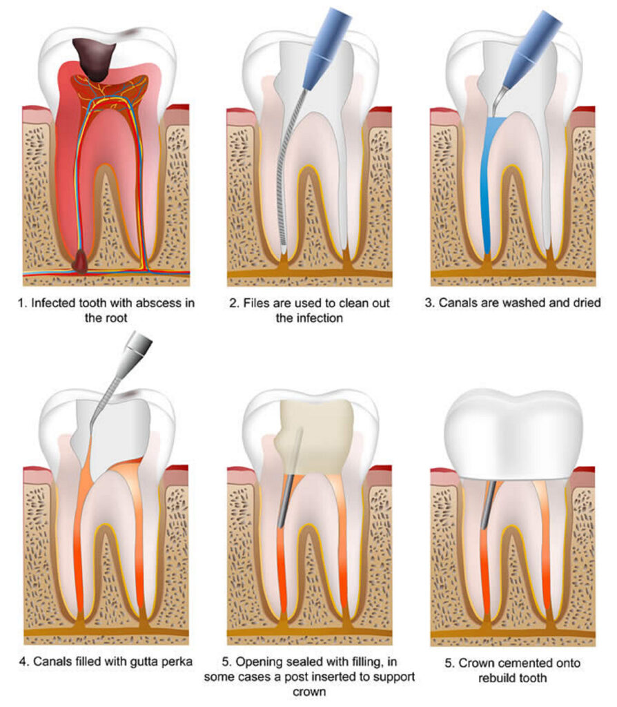 When Root Canal Treatment is Needed?