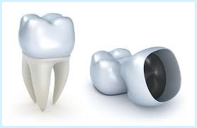 Why Do Dental Crowns Fall Out? The Most Common Reasons!!